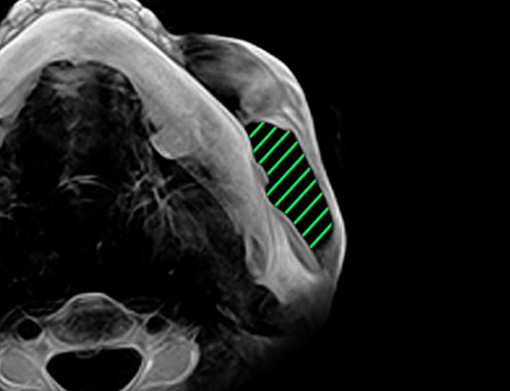 실제 수술환자 CT 전후사진