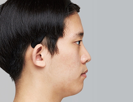 실제 수술환자 전후사진