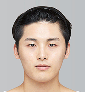 실제 수술환자 전후사진