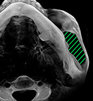 실제 수술환자 ct 전후사진