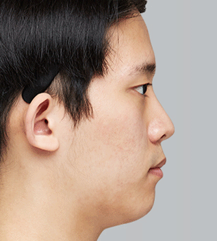 수술환자 전후사진