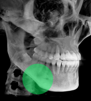 실제 수술환자 ct 전후사진
