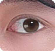 또렷한 눈매교정