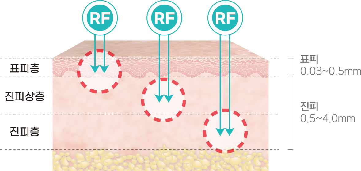 다양한 피부층 타겟팅