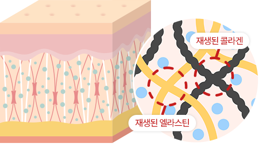 브라운 줄기세포 피부주사